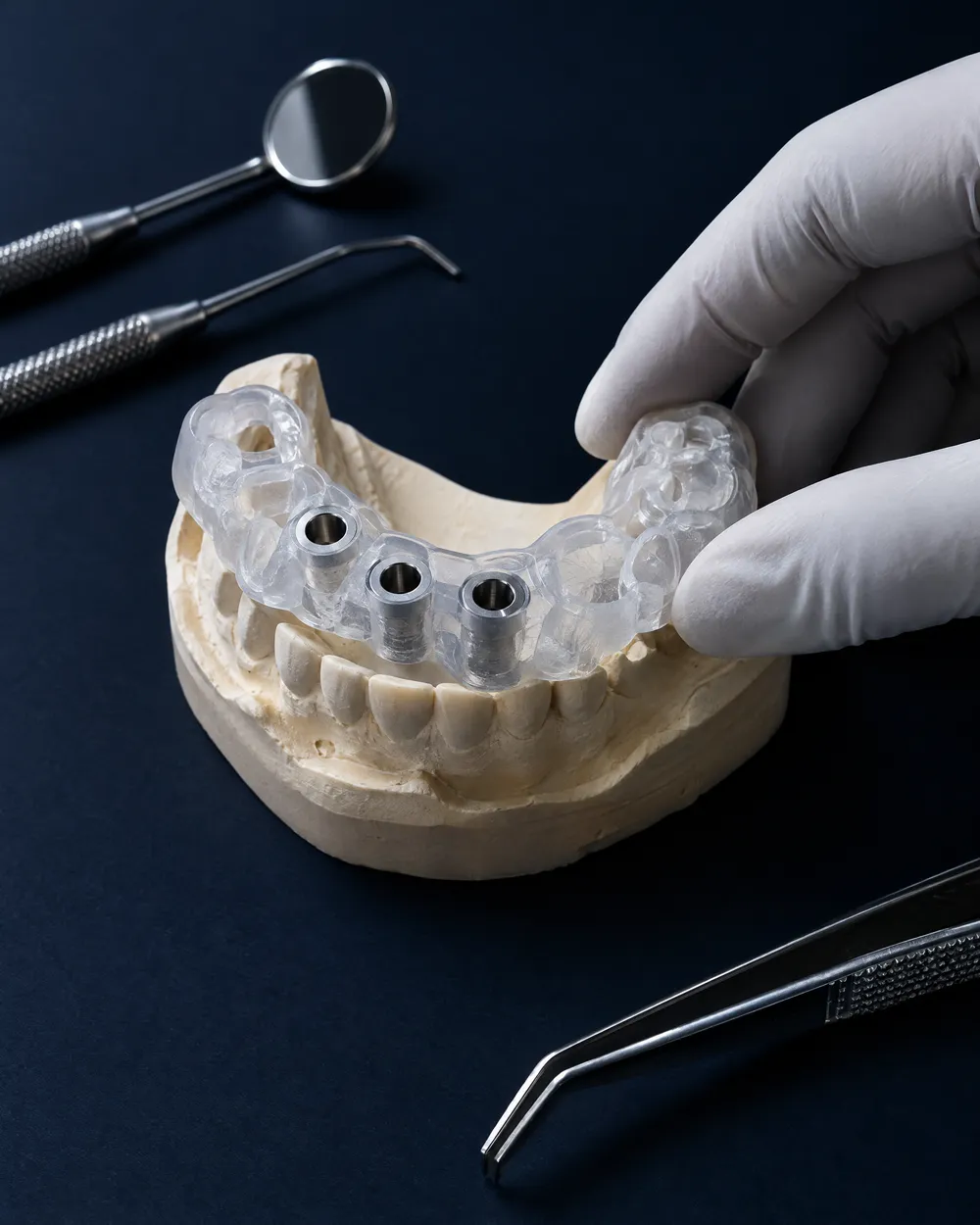 Guia cirúrgico encaixado sobre um modelo dental impresso em 3D